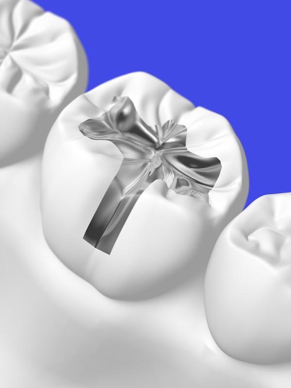 tooth fillings