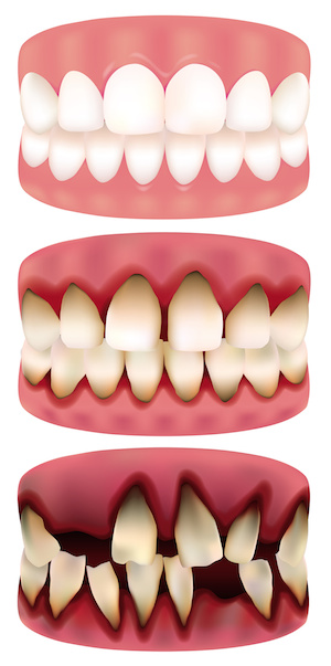 Illustrations of healthy and decaying teeth