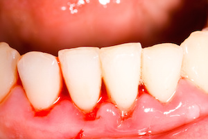 Focus on preventing gingivitis