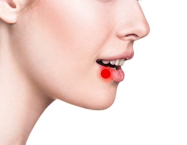 woman with canker sore