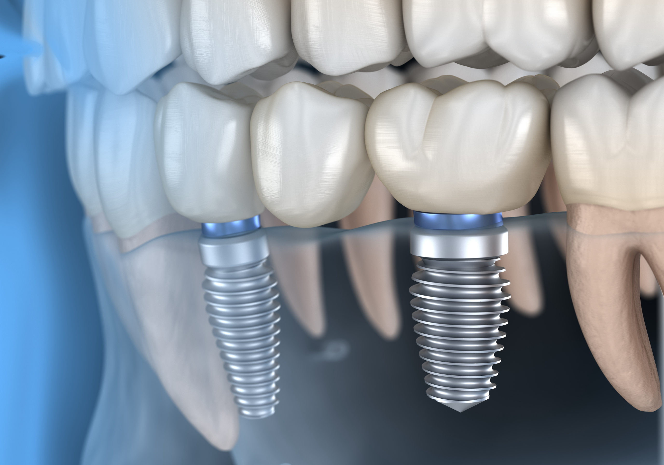 When Do You Need a Filling vs. a Crown? Understanding the Difference