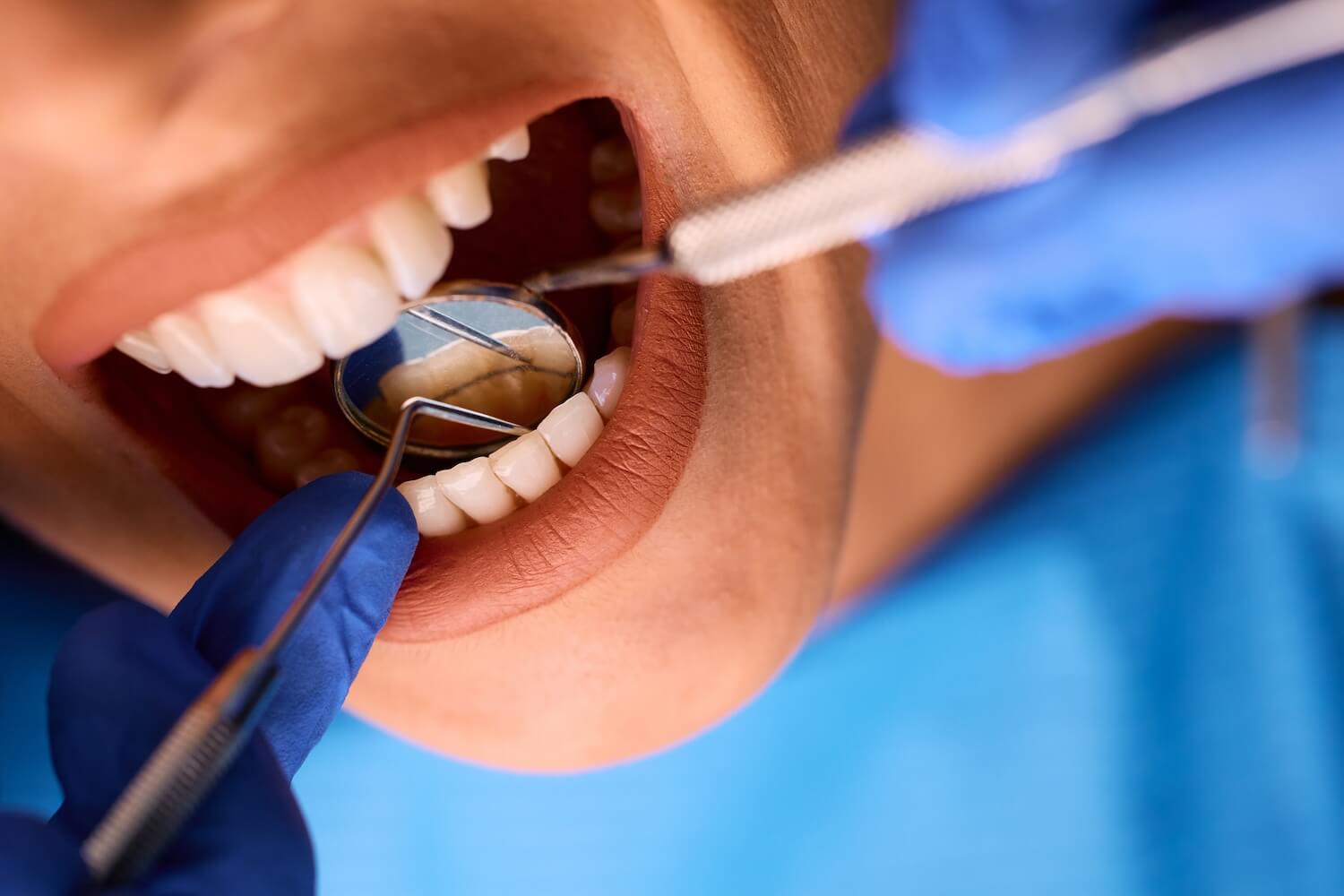 The Tooth That Almost Didn’t Make It: How Dental Crowns Save Smiles